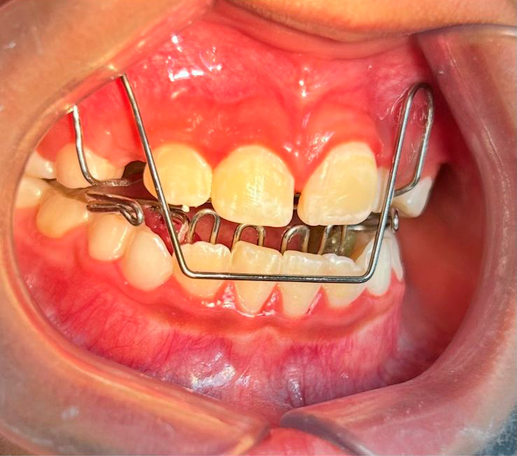 Ortopedia funcional de los maxilares