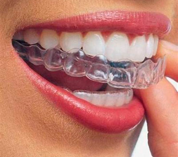 Alineadores dentales igual o mejor que la eficacia de los brackets